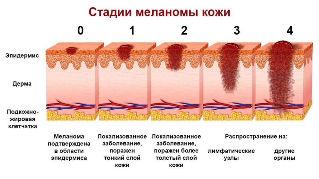 меланома кожи