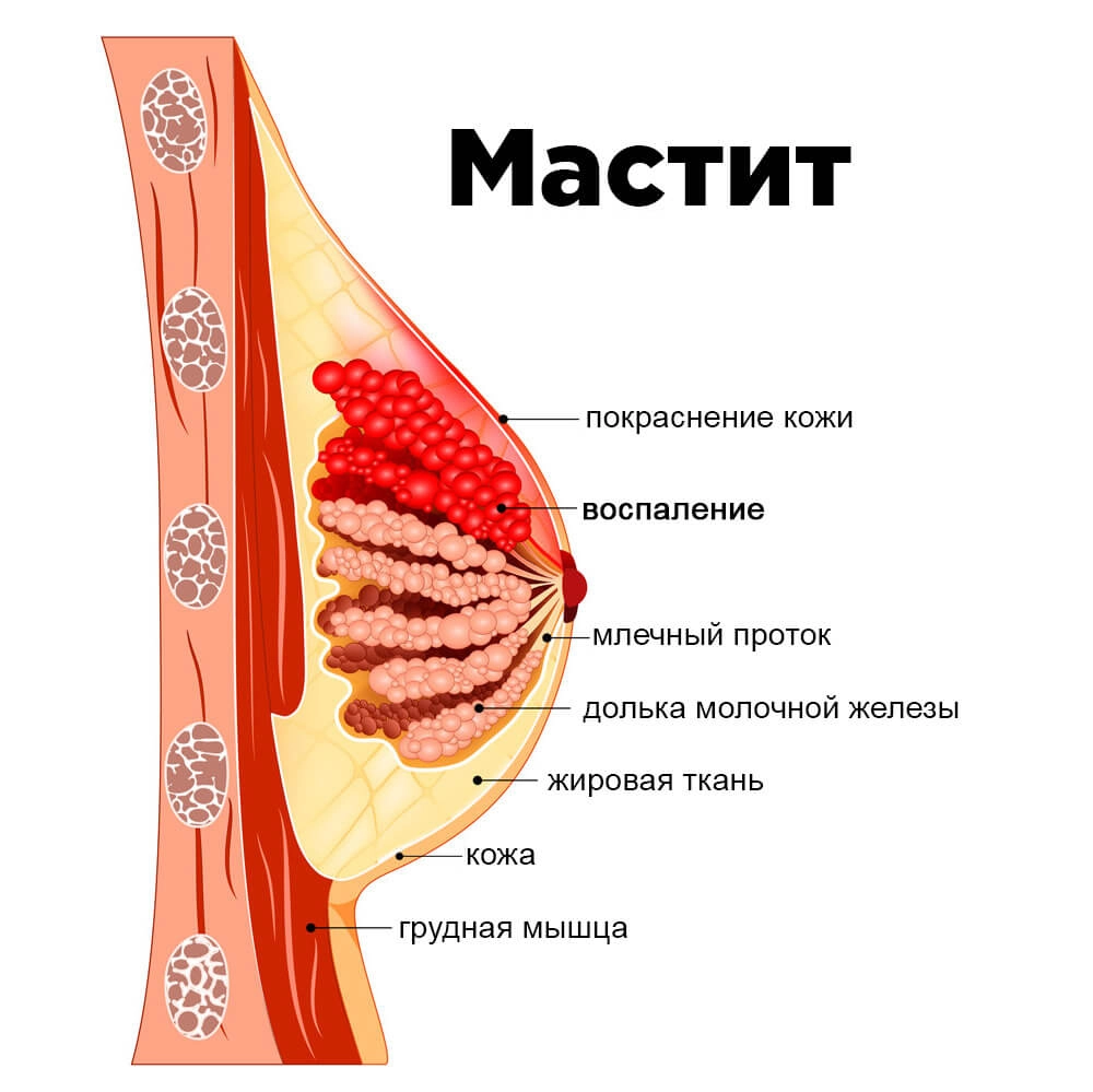 Мастит: профилактика и продуктивное лечение