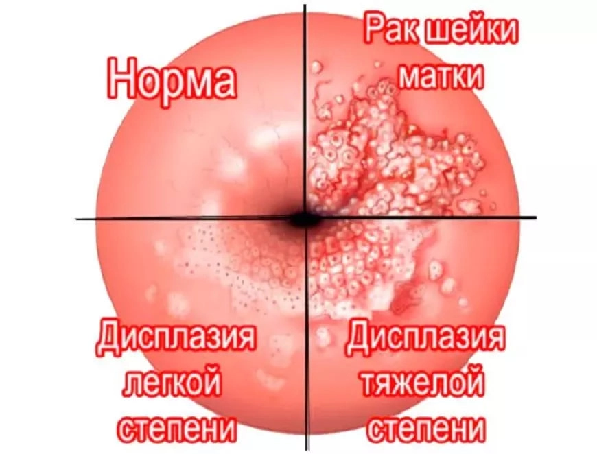 Киста шейки матки: развитие, предпосылки, основы терапии