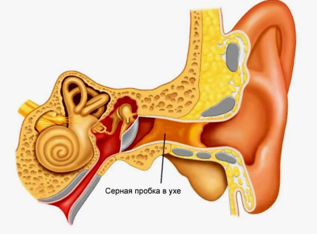 серная пробка в ухе