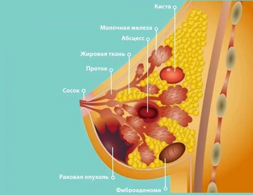 рак молочной железы